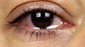 Göz Sulanması Neden Olur? Gözyaşı Dengesizliğinin 5 Olası Sebebi