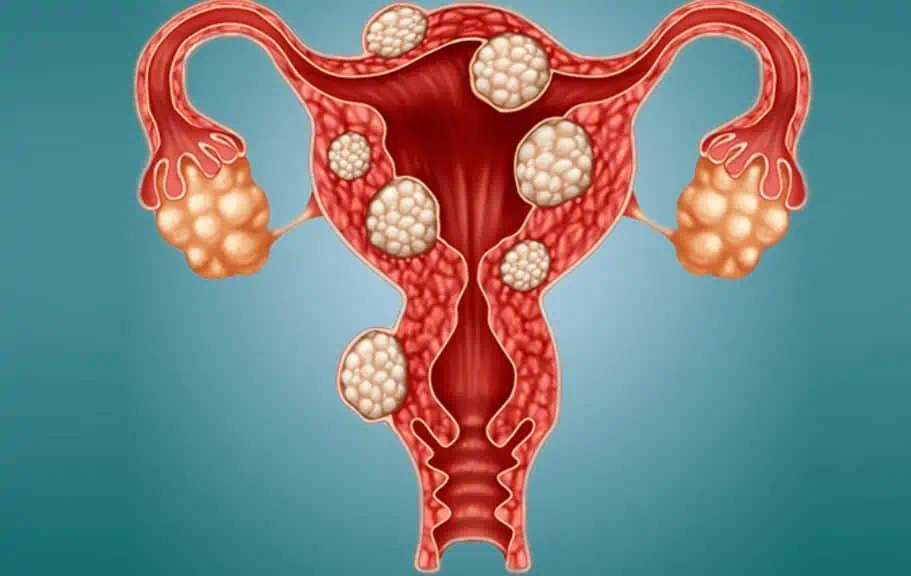 Yumurtalık Kistleri Hakkında Bilmeniz Gereken Her Şey